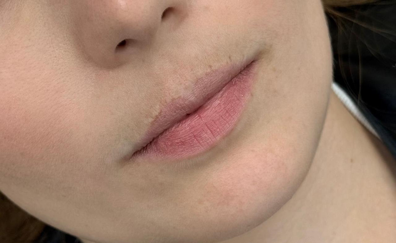 Resultado de preenchimento labial em vista frontal