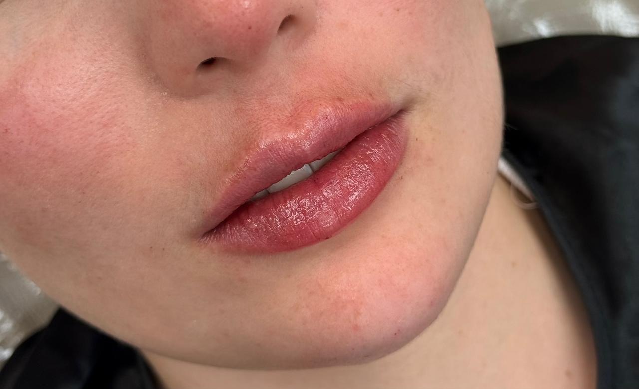 Resultado de preenchimento labial em vista de perfil