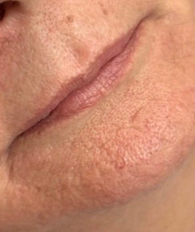 Comparativo de evolução de tratamento estético facial