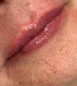 Resultado de tratamento estético facial em vista frontal